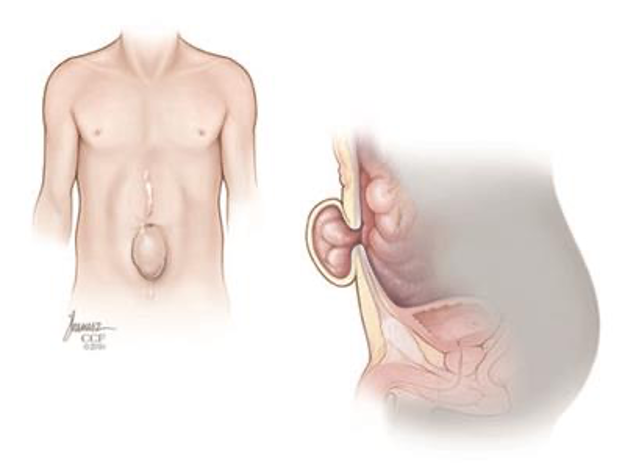 Thoát vị bụng